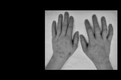 Duzentos mil portugueses com formas graves de Dermatite Atópica