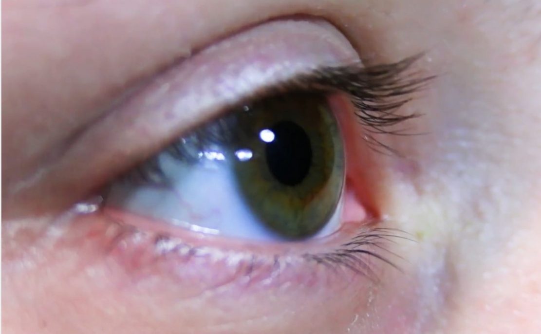 visão - olhos - oftalmologia - saúde - doenças raras oculares